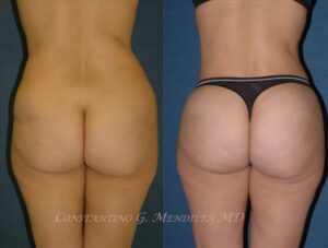 BUTT-AUGMENTATION-101a-2