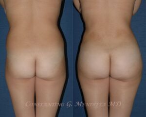 BUTT-AUGMENTATION-52-2