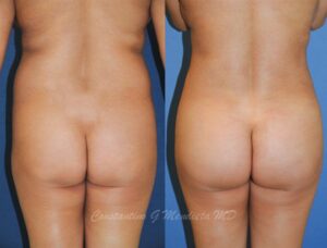 butt-augmentatin-results-miami