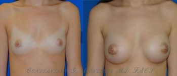 BREAST-AUGMENNTATIONS-79