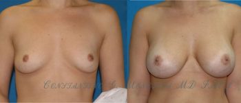 BREAST-AUGMENTATION-101