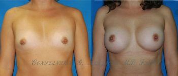 BREAST-AUGMENTATION-102