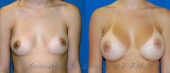 BREAST-AUGMENTATION-103