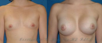 BREAST-AUGMENTATION-106