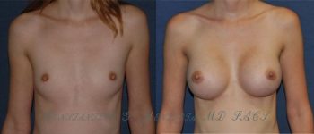 BREAST-AUGMENTATION-14