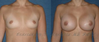 BREAST-AUGMENTATION-5