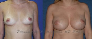 BREAST-AUGMENTATION-6