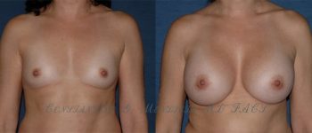 BREAST-AUGMENTATION-7