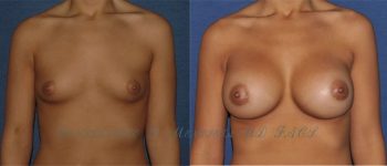 BREAST-AUGMENTATIONS-16